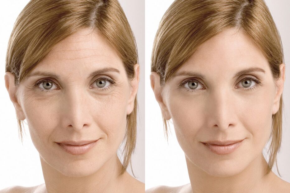Experiences before and after using Milana intenskin cream