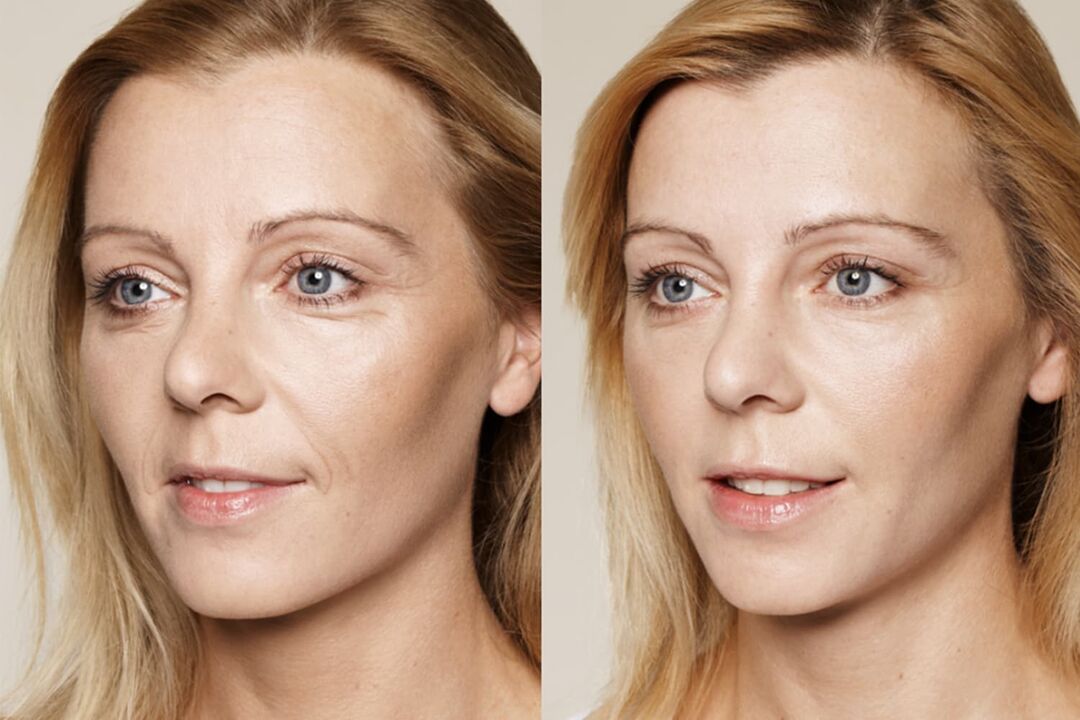 Experiences before and after using Valeria intenskin cream